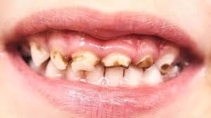 Dental Caries